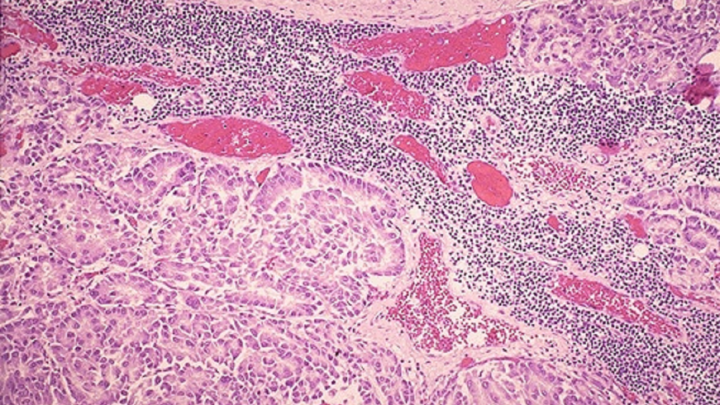 AUMENTO DE 60% DE CÁNCER EN EL MUNDO EN PRÓXIMOS DOS DECENIOS.