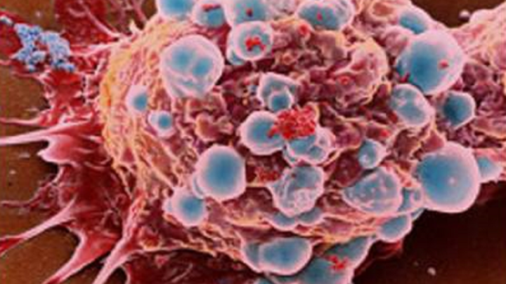 DETECCIÓN TEMPRANA DE CÁNCER