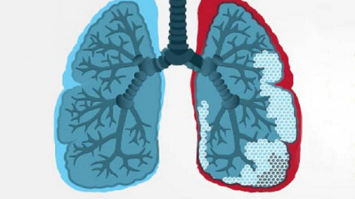 FPI Y ESCLERODERMIA, ENFERMEDADES RARAS
