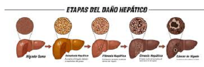 UN HÍGADO SANO UN HÍGADO SANO