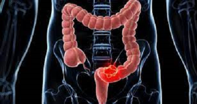 CÁNCER COLORRECTAL