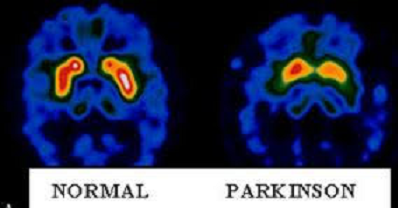 TRATAMIENTO CON CIRUGÍA A PACIENTES CON ENFERMEDAD DE PARKINSON