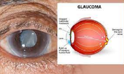 GLAUCOMA PUEDE CAUSAR CEGUERA IRREVERSIBLE