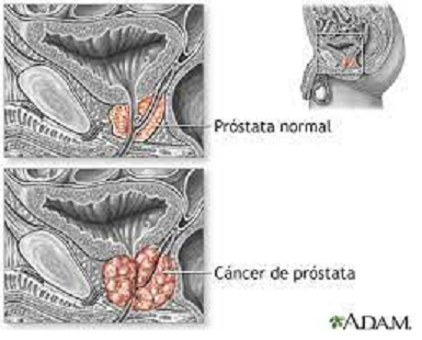 CÁNCER DE PRÓSTATA