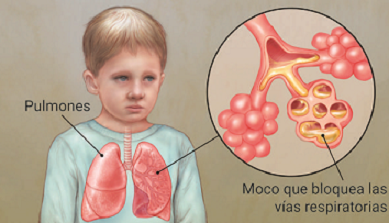 FIBROSIS QUÍSTICA SE DETECTA CON TAMIZ NEONATAL AMPLIADO