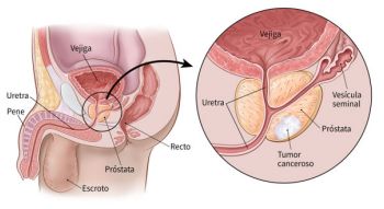 HASTA 80% DE CASOS DE CÁNCER DE PRÓSTATA SON CURABLES