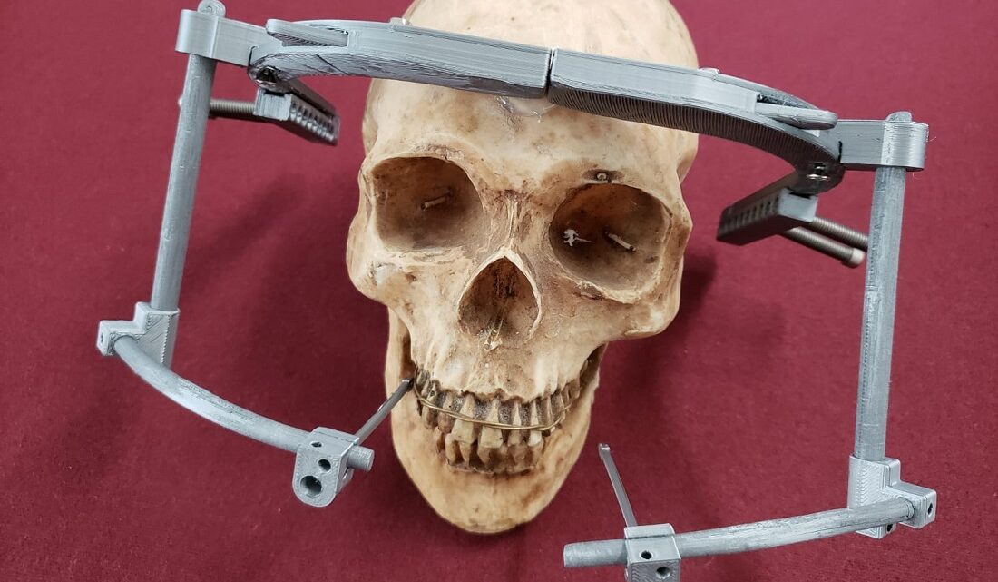 DISPOSITIVO MECÁNICO IMPRESO EN 3D PARA CORREGIR DEFORMACIONES CRANEALES DISPOSITIVO MECÁNICO IMPRESO EN 3D PARA CORREGIR DEFORMACIONES CRANEALES