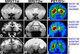 ESTUDIAN MECANISMOS PARA RETRASAR SÍNTOMAS DE LA ENFERMEDAD DE HUNTINGTON