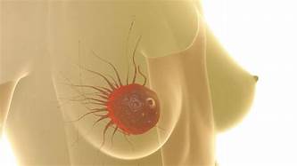 LOS BULTOS EN LOS SENOS