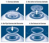 ALTA DEMANDA DE TRASPLANTES DE ÓRGANOS, VINCULADA CON DIABETES