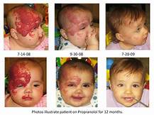 EL HEMANGIOMA INFANTIL