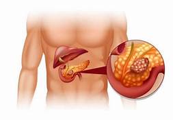 TUMORES NEUROENDOCRINOS DE PÁNCREAS