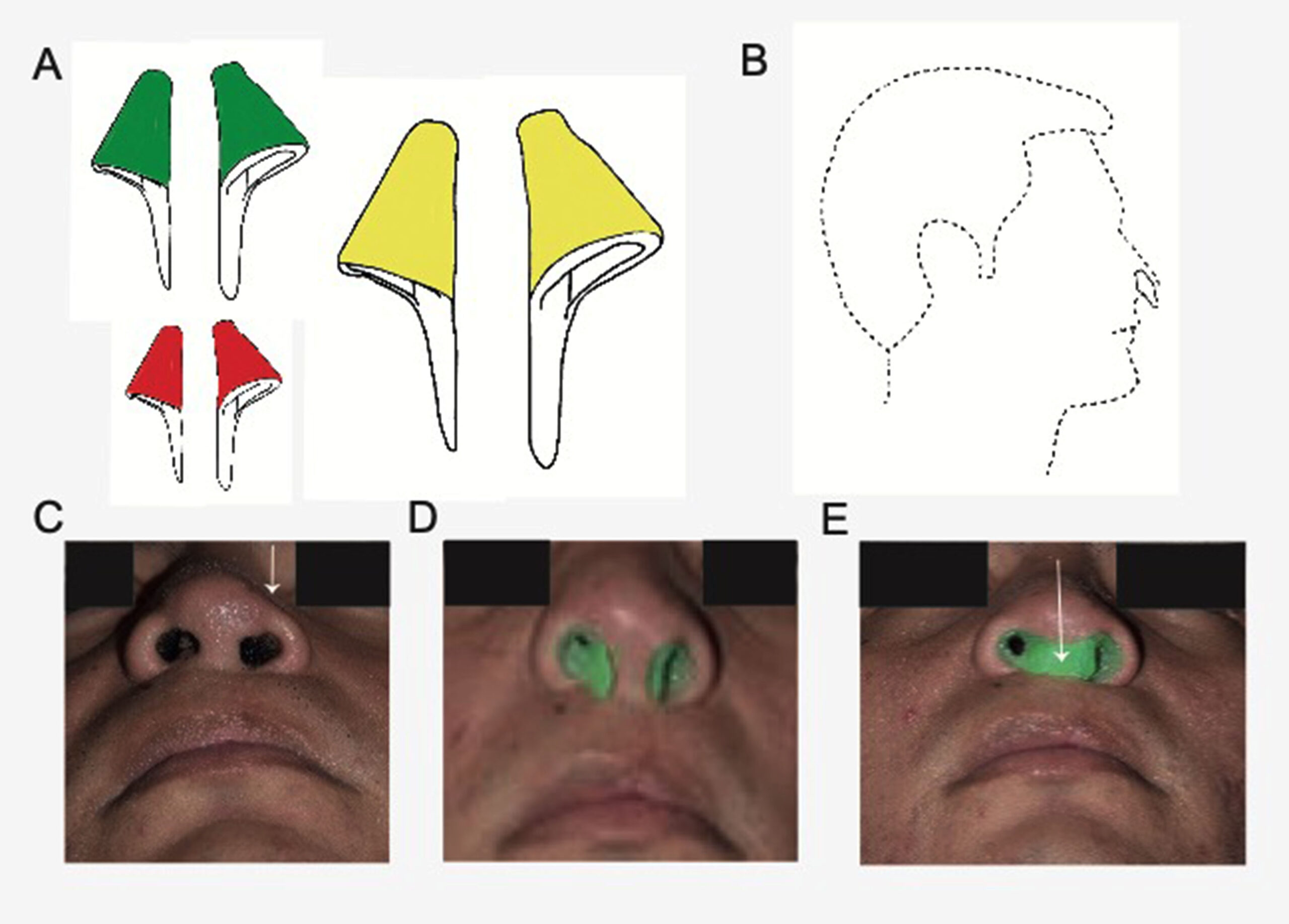 MEJORAN SIMETRÍA DEL ALA NASAL EN PACIENTES CON LABIO Y PALADAR HENDIDO