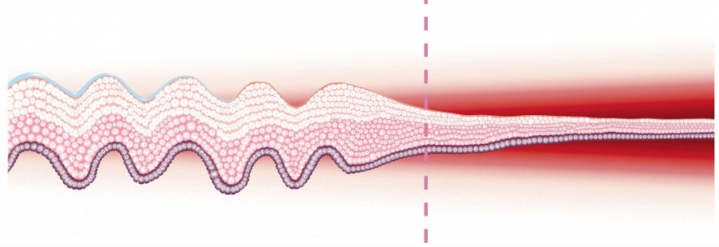 SEIS DE 10 MUJERES CON MENOPAUSIA PRESENTAN ATROFIA VAGINAL