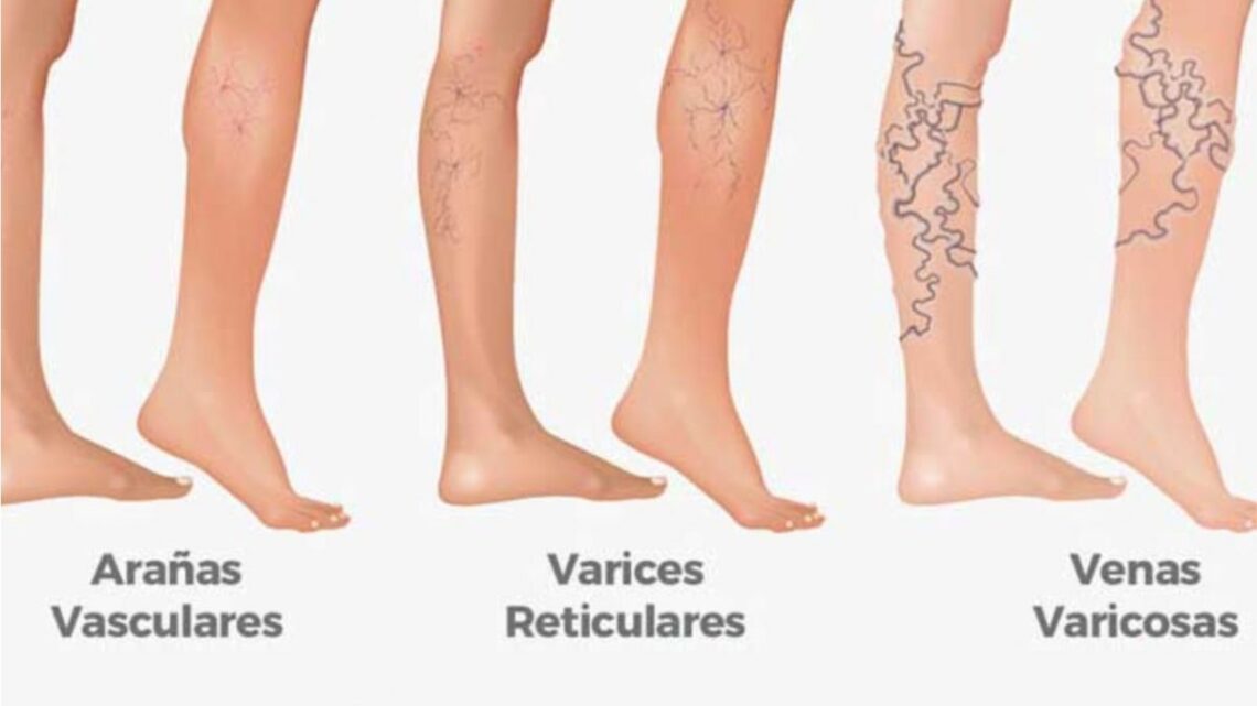 LAS VENAS VARICOSAS LAS VENAS VARICOSAS