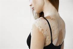 ENFOQUE INTEGRAL A LA ATENCIÓN DEL VITILIGO ENFOQUE INTEGRAL A LA ATENCIÓN DEL VITILIGO