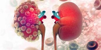 CÁNCER DE RIÑÓN CÁNCER DE RIÑÓN