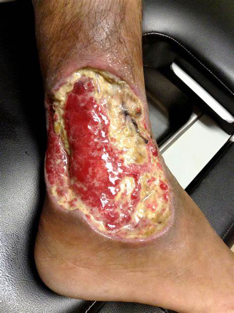 ABREN CLÍNICAS DE HERIDAS Y ESTOMAS, Y DE TERAPIA DE INFUSIÓN EN HOSPITAL NACIONAL HOMEOPÁTICO ABREN CLÍNICAS DE HERIDAS Y ESTOMAS, Y DE TERAPIA DE INFUSIÓN EN HOSPITAL NACIONAL HOMEOPÁTICO