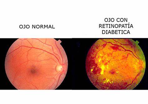 DEGENERACIÓN MACULAR Y RETINOPATÍA DIABÉTICA