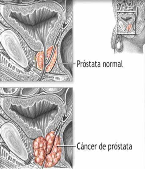 EN MÉXICO NUEVO TRATAMIENTO CONTRA CÁNCER DE PRÓSTATA NO METASTÁSICO RESISTENTE A CASTRACIÓN