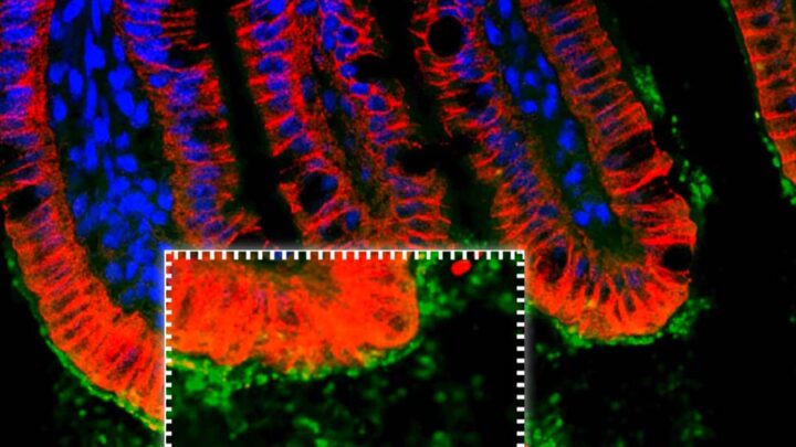 INFECCIÓN DE ESCHERICHIA COLI ASOCIADA CON DESNUTRICIÓN EN NIÑOS