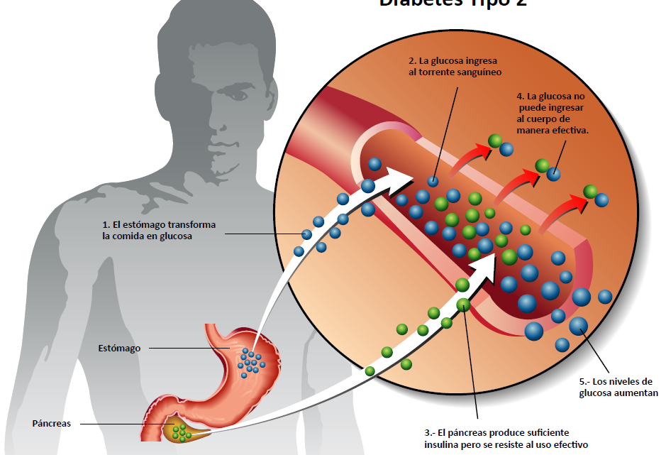 DÍA MUNDIAL DE LA DIABETES, 14 NOVIEMBRE, DATOS NACIONALES DÍA MUNDIAL DE LA DIABETES, 14 NOVIEMBRE, DATOS NACIONALES