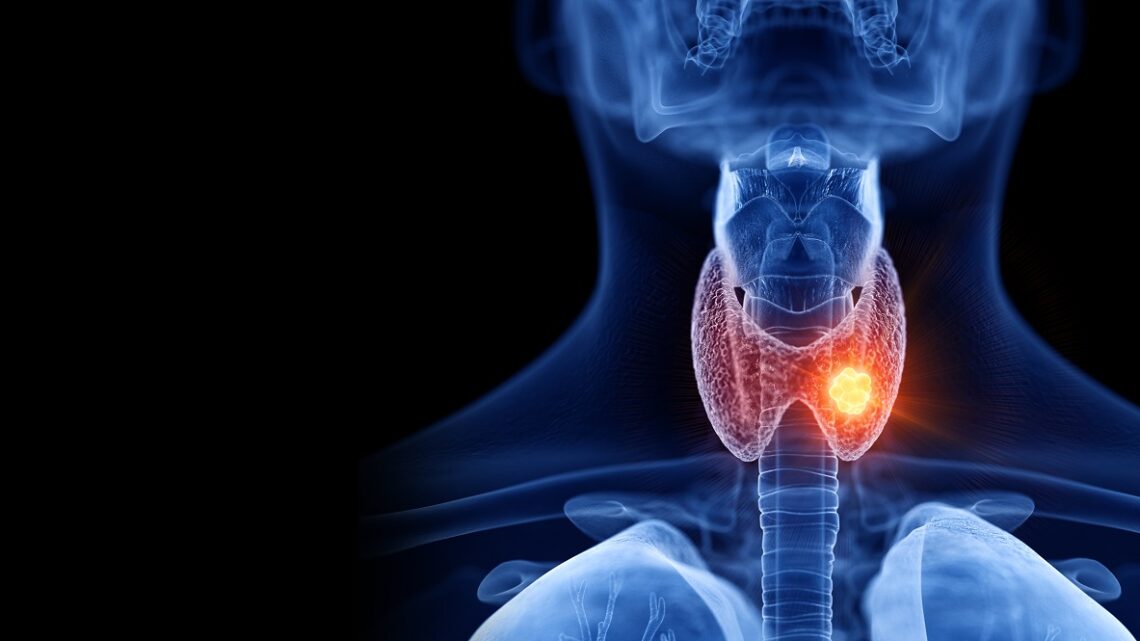 PROCEDIMIENTO MÍNIMAMENTE INVASIVO PARA NÓDULOS TIROIDEOS