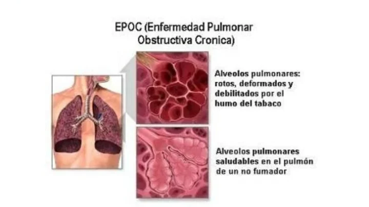 PERSONAS CON EPOC DEBEN VACUNARSE CONTRA INFLUENZA Y NEUMOCOCO