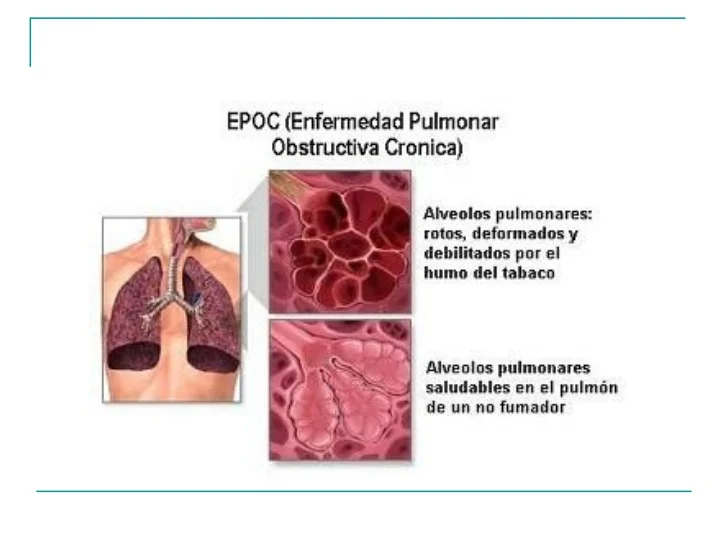 PERSONAS CON EPOC DEBEN VACUNARSE CONTRA INFLUENZA Y NEUMOCOCO PERSONAS CON EPOC DEBEN VACUNARSE CONTRA INFLUENZA Y NEUMOCOCO