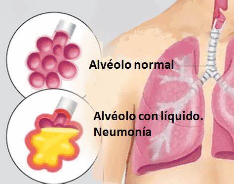 VACUNACIÓN PREVIENE ENFERMEDADES GRAVES COMO NEUMONÍA