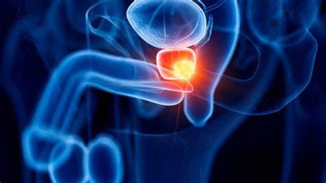 CÁNCER DE PULMÓN Y PRÓSTATA