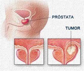 DETECCIÓN DE CÁNCER DE PRÓSTATA