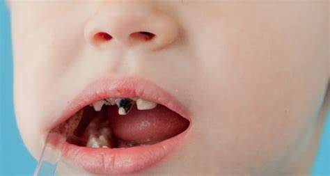 NOVEDOSO TRATAMIENTO DENTAL PARA INFANTES