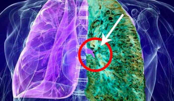 PRIMERA TERAPIA PARA PACIENTES CON FIBROSIS PULMONAR PROGRESIVA