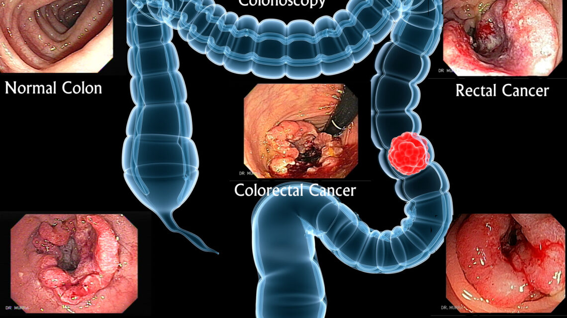 DETECCIÓN GRATUITA DE CÁNCER COLORRECTAL EN EL INCan DETECCIÓN GRATUITA DE CÁNCER COLORRECTAL EN EL INCan