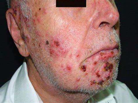 HERPES ZÓSTER, ENFERMEDAD VIRAL POCO CONOCIDA QUE LLEGA CON EL ENVEJECIMIENTO