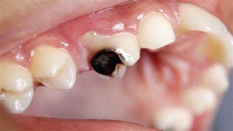 AFECCIONES BUCALES EN LA POBLACIÓN MEXICANA