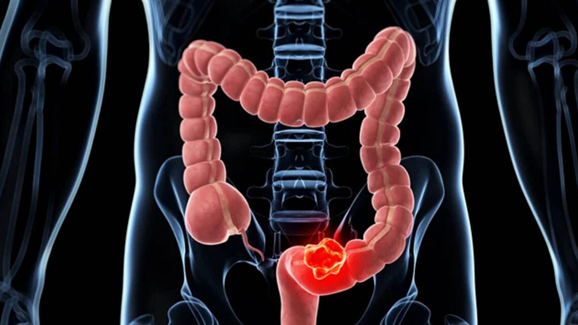 CÁNCER DE COLON CÁNCER DE COLON