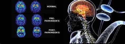 CALIDAD DE VIDA AÚN CON PARKINSON