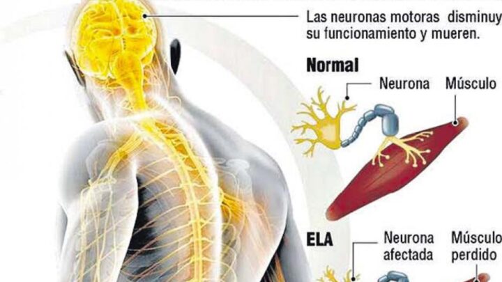 LA LOCOMOCIÓN EN LA ESCLEROSIS LATERAL AMIOTRÓFICA