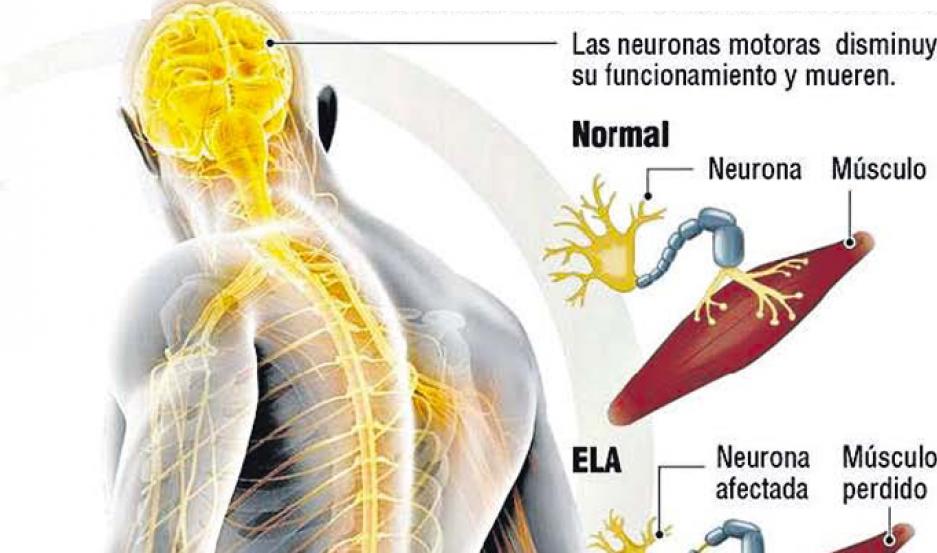 LA LOCOMOCIÓN EN LA ESCLEROSIS LATERAL AMIOTRÓFICA