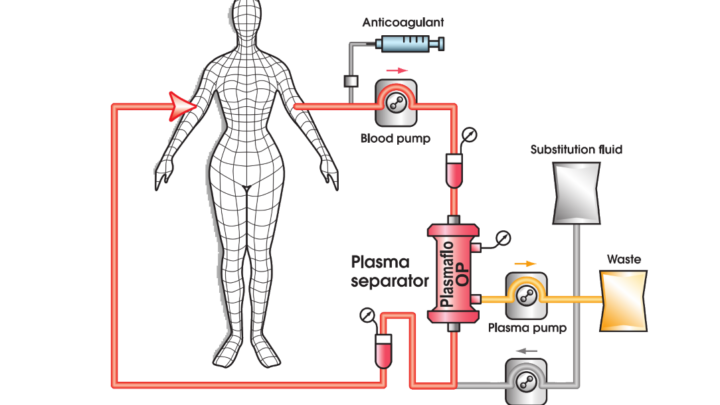 PLASMAFÉRESIS PARA ESCLEROSIS MÚLTIPLE