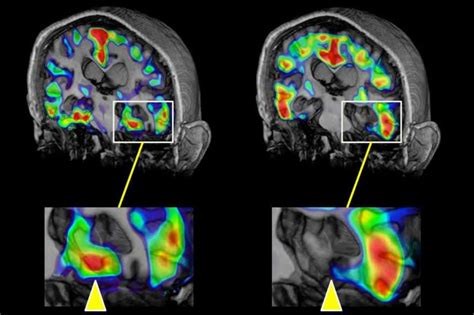 BIOMARCADORES PARA DETECTAR ALZHEIMER CON INTELIGENCIA ARTIFICIAL