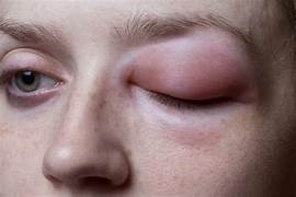 HASTA 21 AÑOS PUEDE TARDAR DIAGNOSTICAR EL ANGIOEDEMA HEREDITARIO