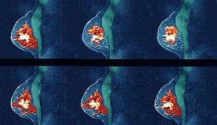 TENER TEJIDO MAMARIO DENSO ¿ES BUENO O MALO?