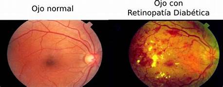 DETECCIÓN OPORTUNA DE LA RETINOPATÍA DIABÉTICA