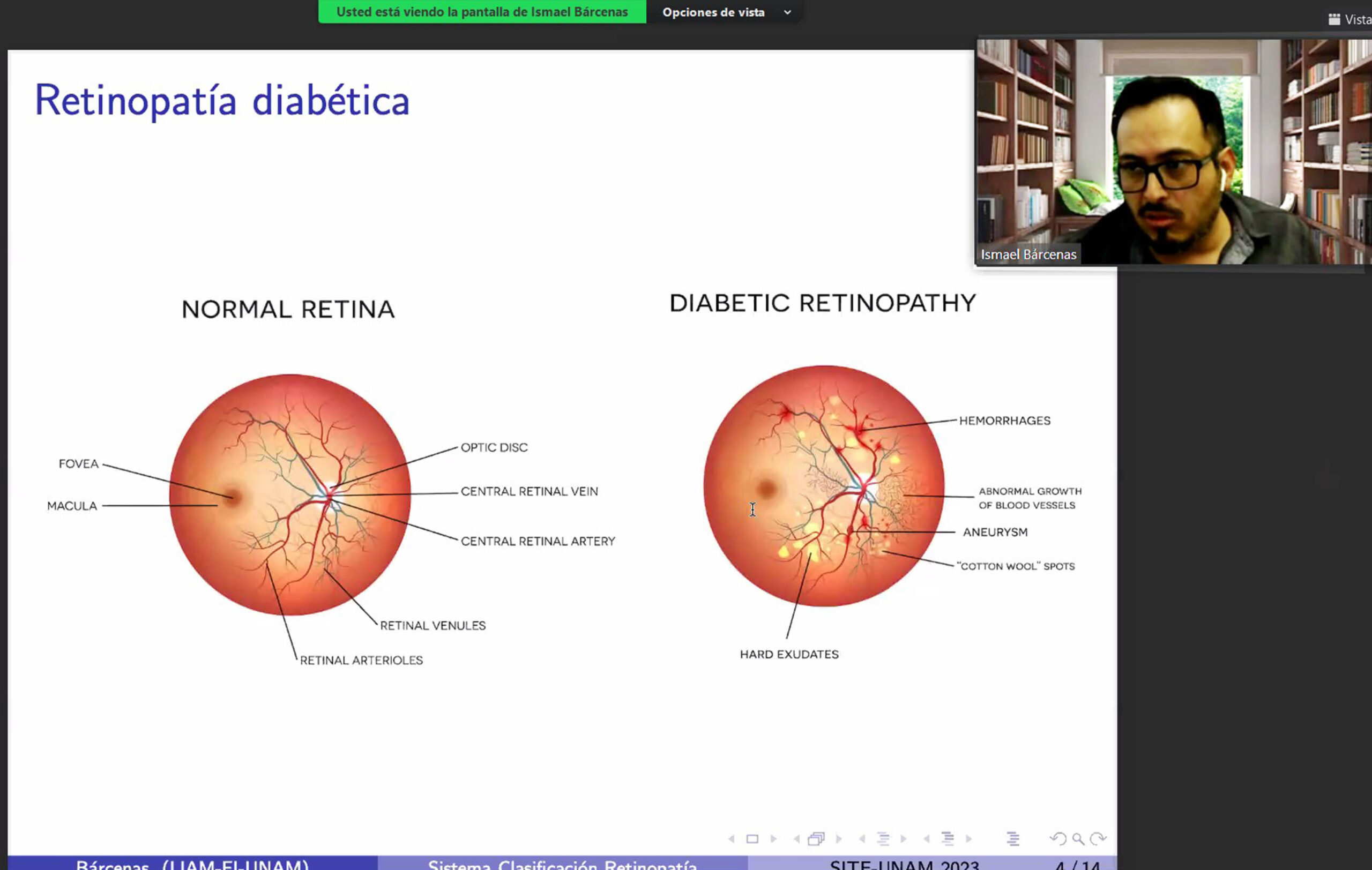 SISTEMA DE DIAGNÓSTICO TEMPRANO DE RETINOPATÍA DIABÉTICA