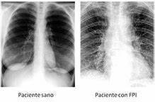 CLÍNICA DE ENFERMEDADES PULMONARES INTERSTICIALES