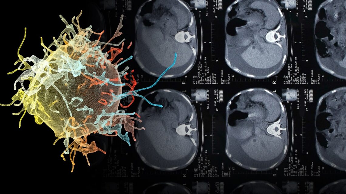 AVANCES EN EL TRASPLANTE DE HÍGADO DE PACIENTES CON CÁNCER