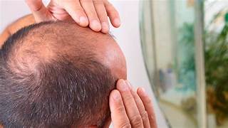 25 MILLONES DE MEXICANOS SON PROPENSOS A LA ALOPECIA